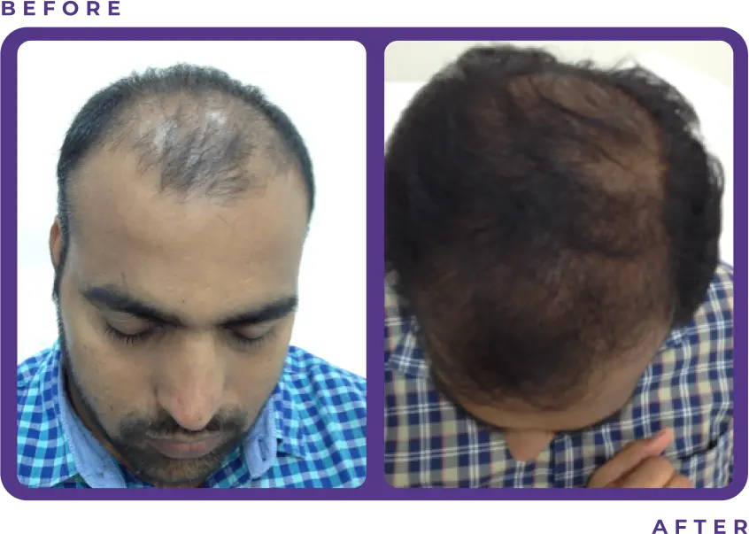 Before and After