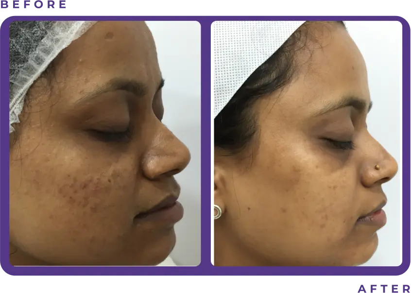 Before and After
