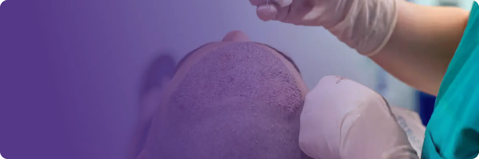 FUE Hair Treatment